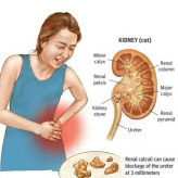 خرید آنلاین داروی سنگ کلیه رویال