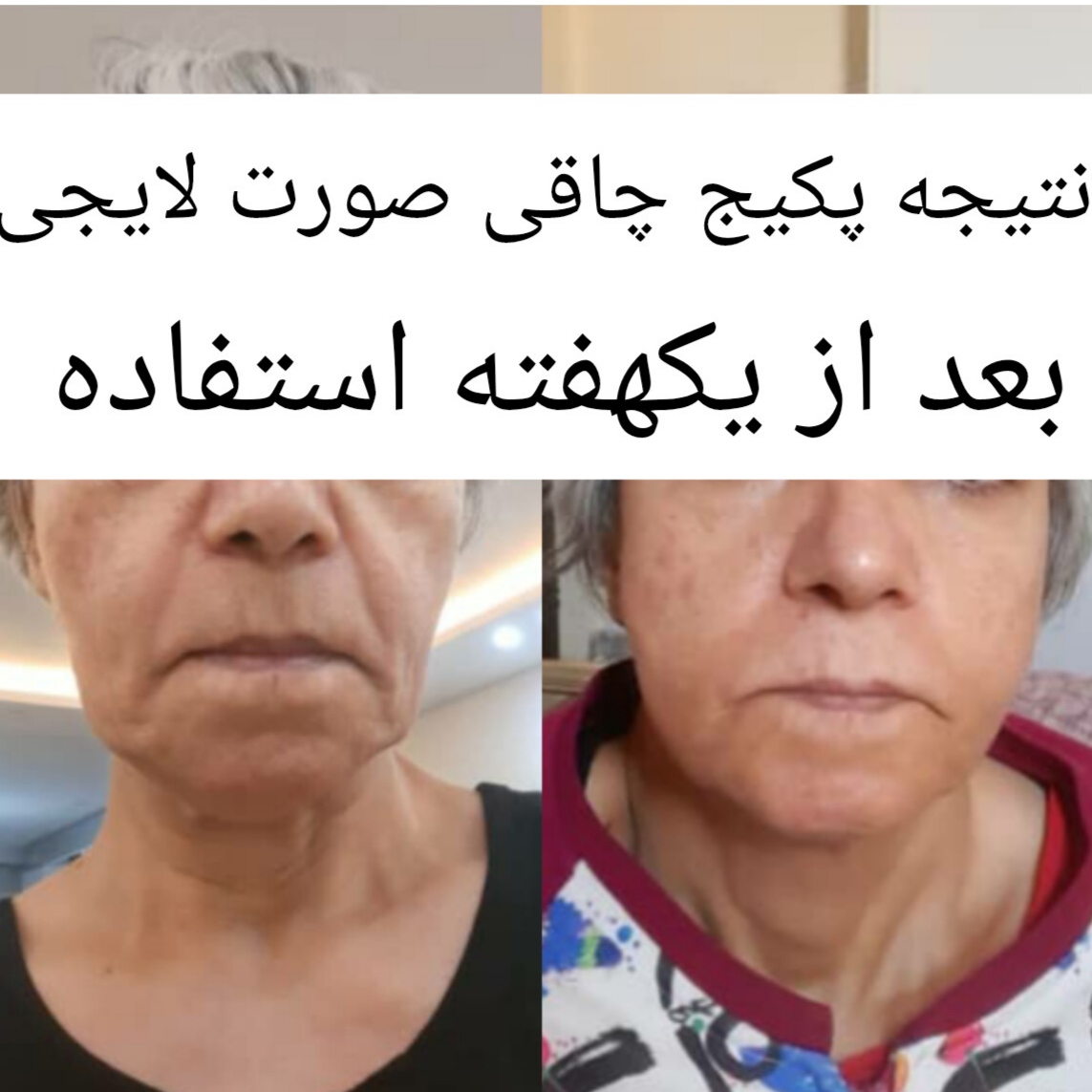 پکیج چاقی صورت با جوانه گندم و کرم کلاژن | صورت پرتر، چهره جوانتر