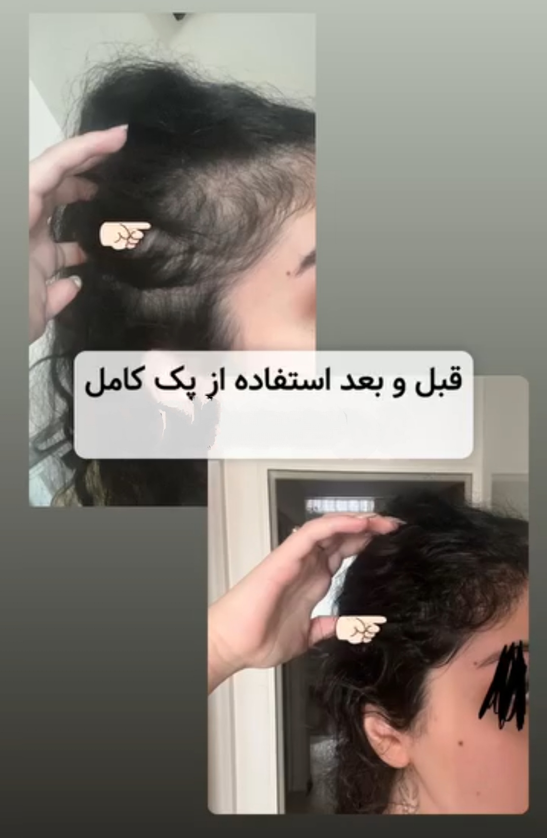 پک کامل رویش مجدد و تقویت مو | کنترل ریزش، تحریک رشد و افزایش ضخامت مو