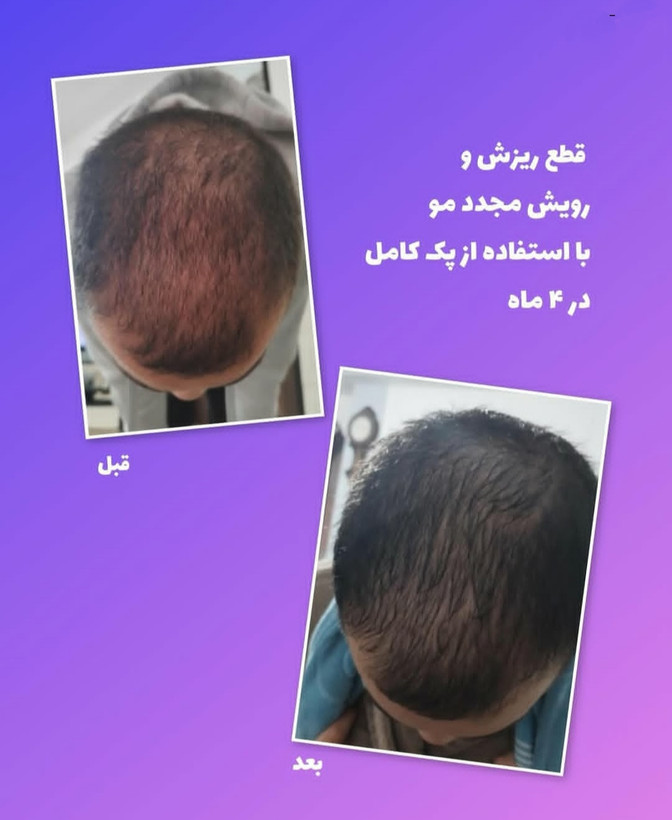 پک کامل رویش مجدد و تقویت مو | کنترل ریزش، تحریک رشد و افزایش ضخامت مو