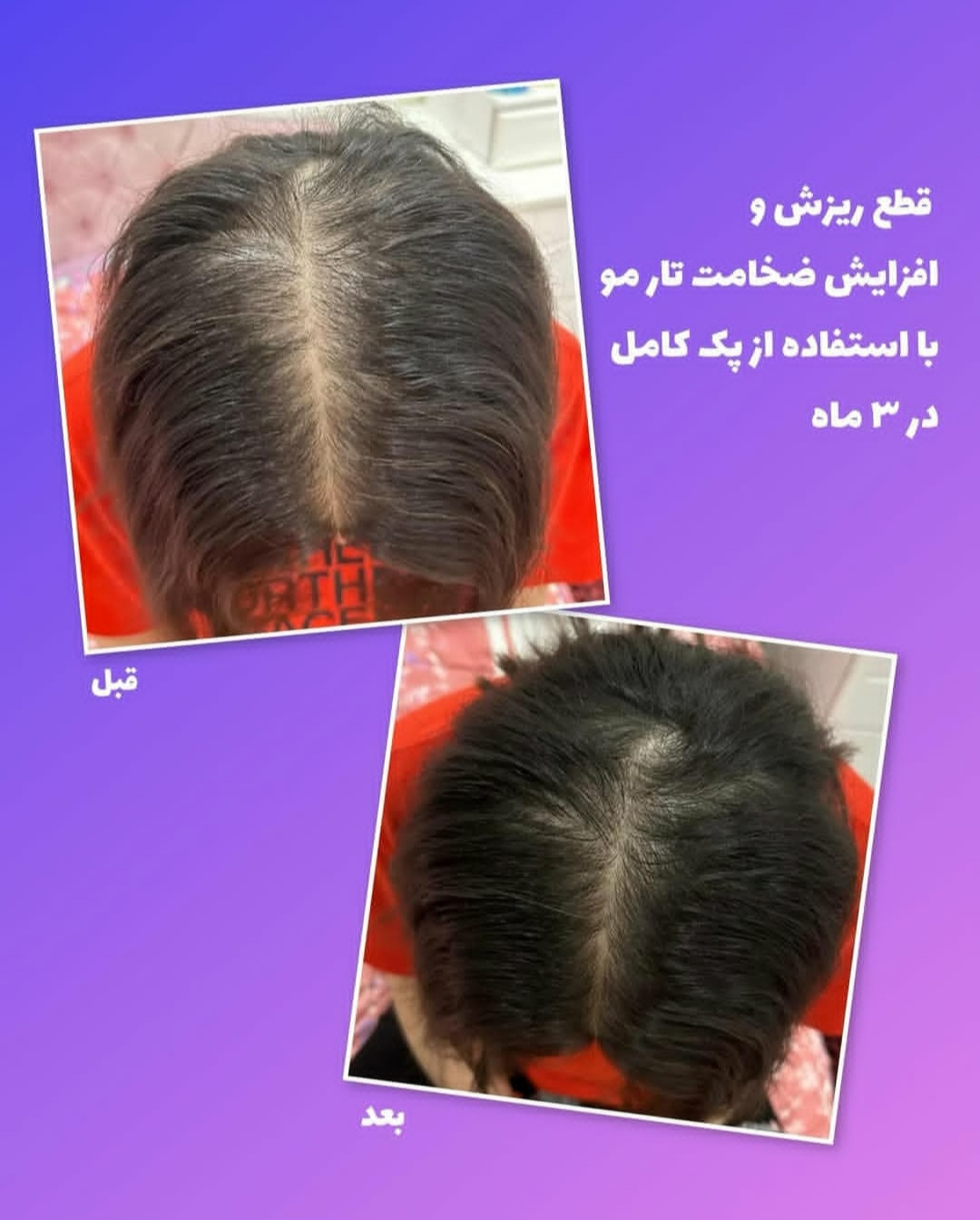 پک کامل رویش مجدد و تقویت مو | کنترل ریزش، تحریک رشد و افزایش ضخامت مو