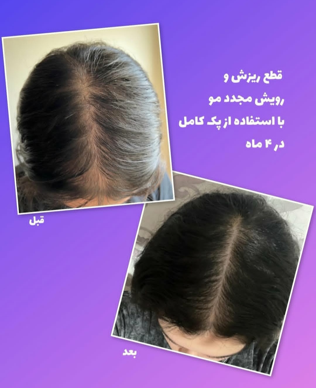 پک کامل رویش مجدد و تقویت مو | کنترل ریزش، تحریک رشد و افزایش ضخامت مو