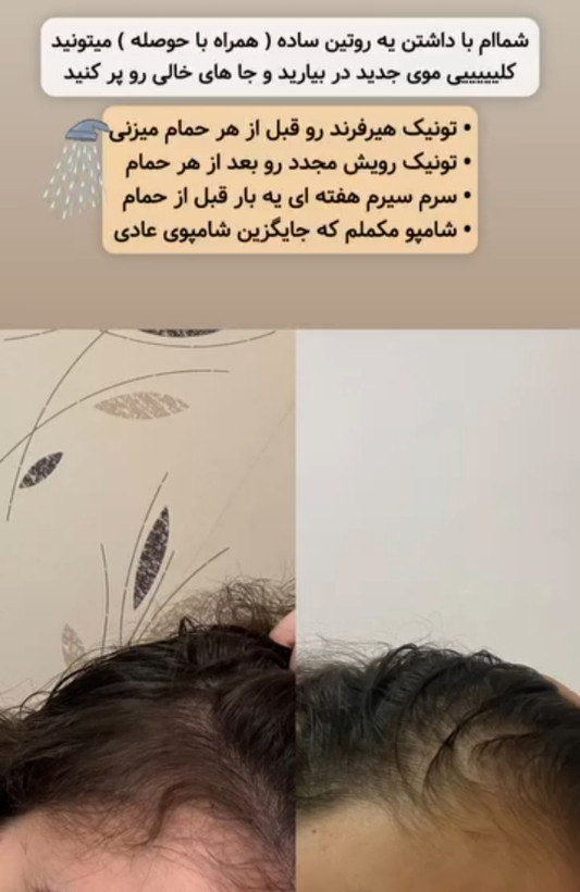 پک کامل رویش مجدد و تقویت مو | کنترل ریزش، تحریک رشد و افزایش ضخامت مو