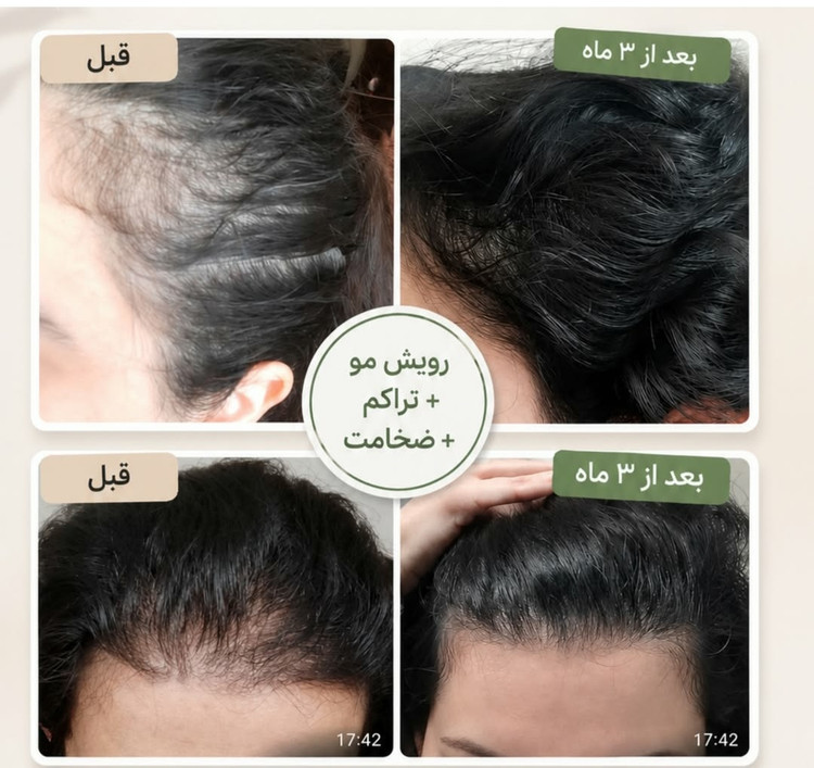 پک اقتصادی تونیک تقویت کننده و رشد مو هیرفرند و رویش مجدد اصل